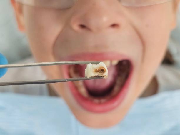 Best Urgent Tooth Repair  in Manson, WA
